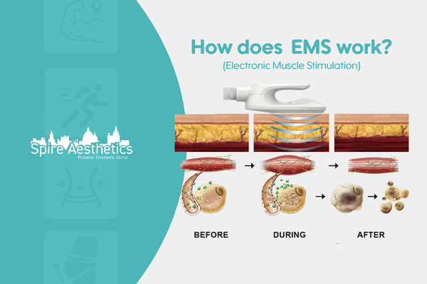 EMS treatment for post pregnancy weight loss treatment Stourbridge