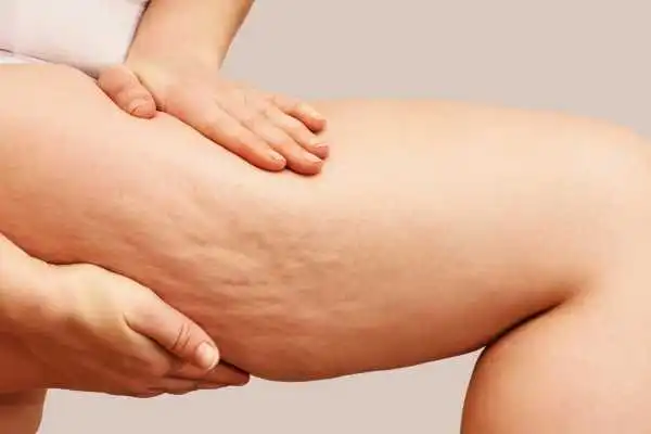 Image of woman showing leg with cellulite Stourbridge
