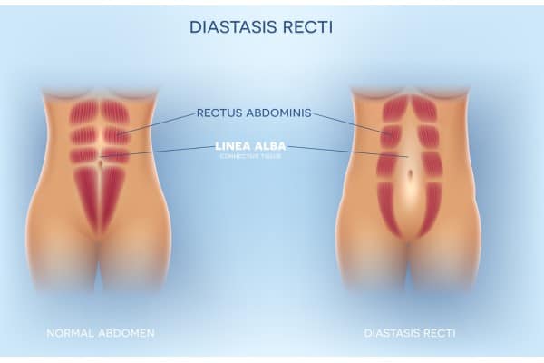 What Non-Surgical Options Are Available for Diastasis Recti Stourbridge?