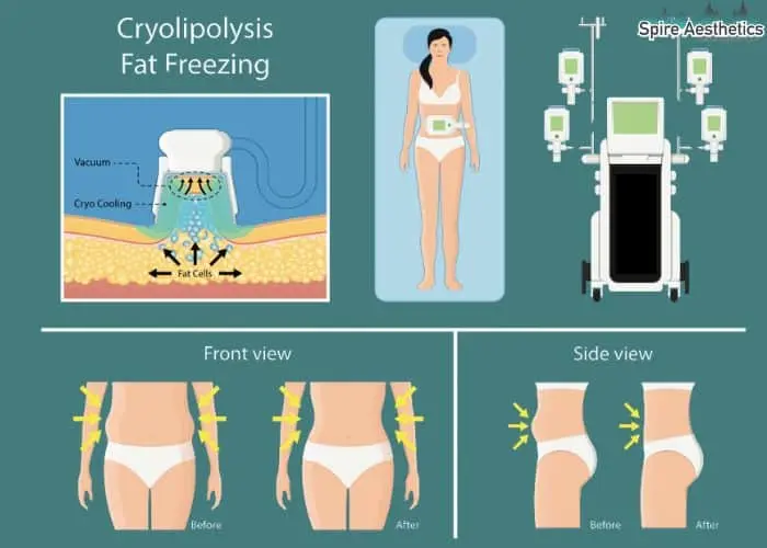 Fat freezing treatment Stourbridge benefits for competitions to remove stubborn fat deposits.
