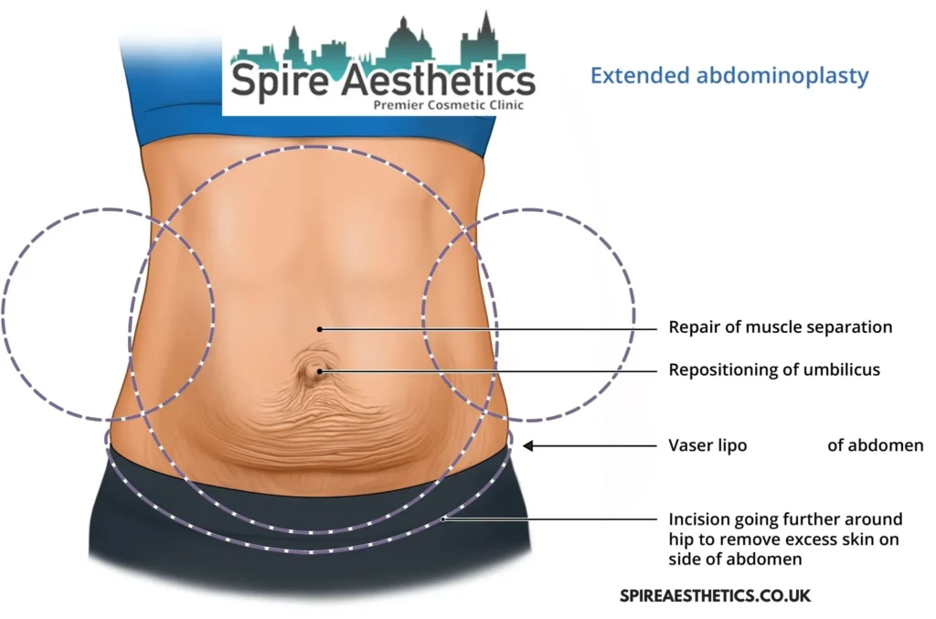 Understanding Loose Skin After Gastric Band Stourbridge Surgery and HIFU Treatment