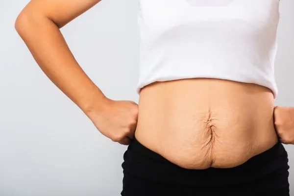 Image of a woman's stomach after weight loss with sagging skin following a gastric band Stourbridge