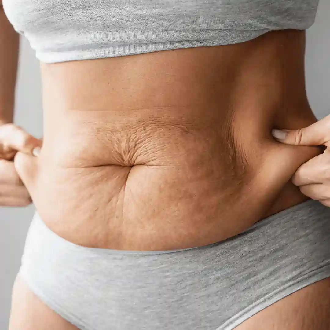 Is It Normal to Have Loose Skin After Pregnancy Stourbridge?