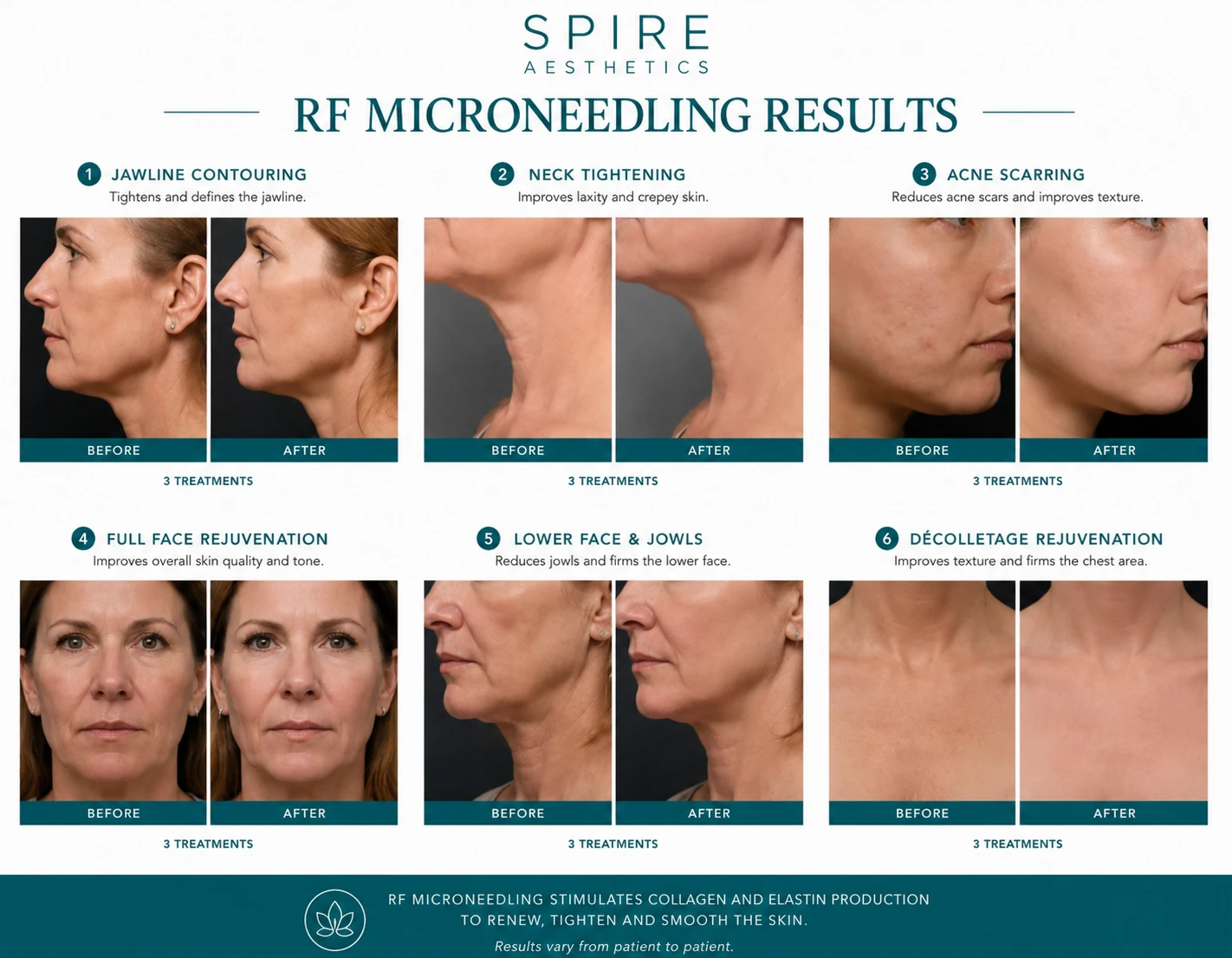 RF Microneedling Skin tightening Stourbridge results