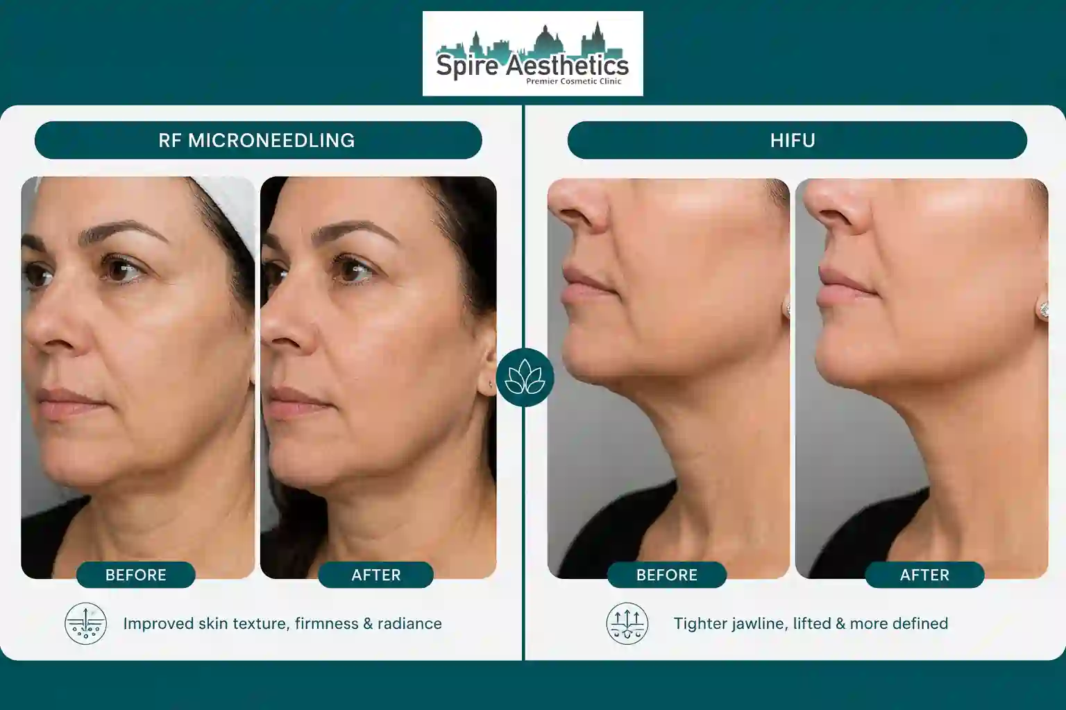 Can RF Microneedling and HIFU Be Combined Stourbridge?