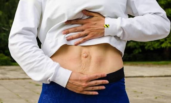 When Could Diastasis Recti Be the Missing Piece of the Puzzle Stourbridge?