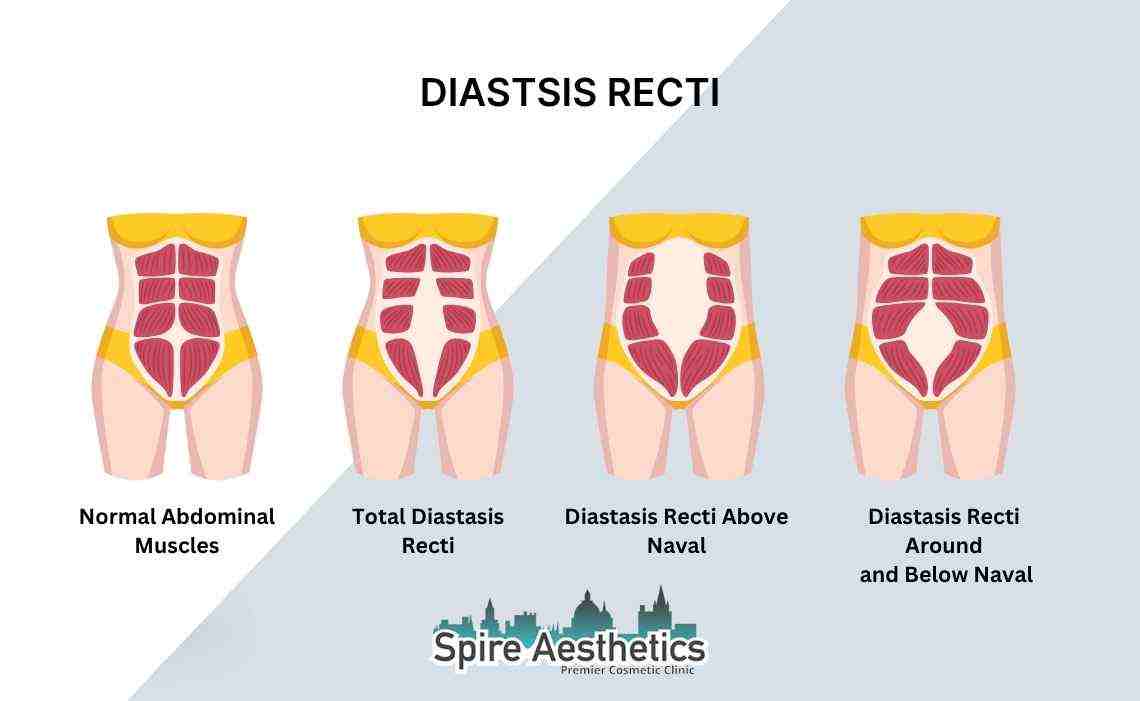 Is Non-Surgical Diastasis Recti Treatment Right for You? Common Concerns Answered Stourbridge